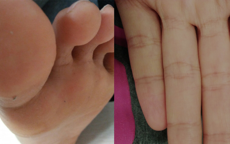 Tình trạng da chân và tay của Hạnh sau 3 tháng điều trị với liệu pháp thảo dược Quân dân 102