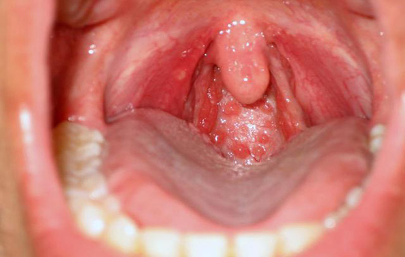 Viêm họng nếu không được chữa trị đúng cách sẽ gây ra nhiều biến chứng nguy hiểm