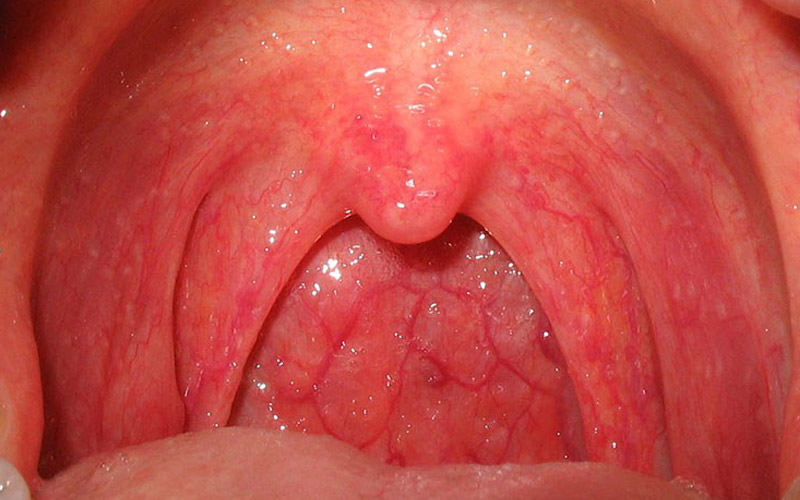Viêm họng do virus là gì? Bệnh có nguy hiểm không