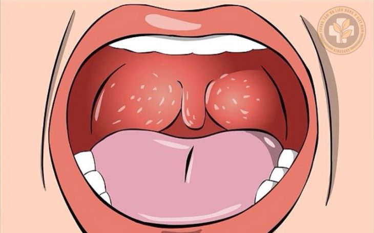 Viêm họng hạt có lây không?