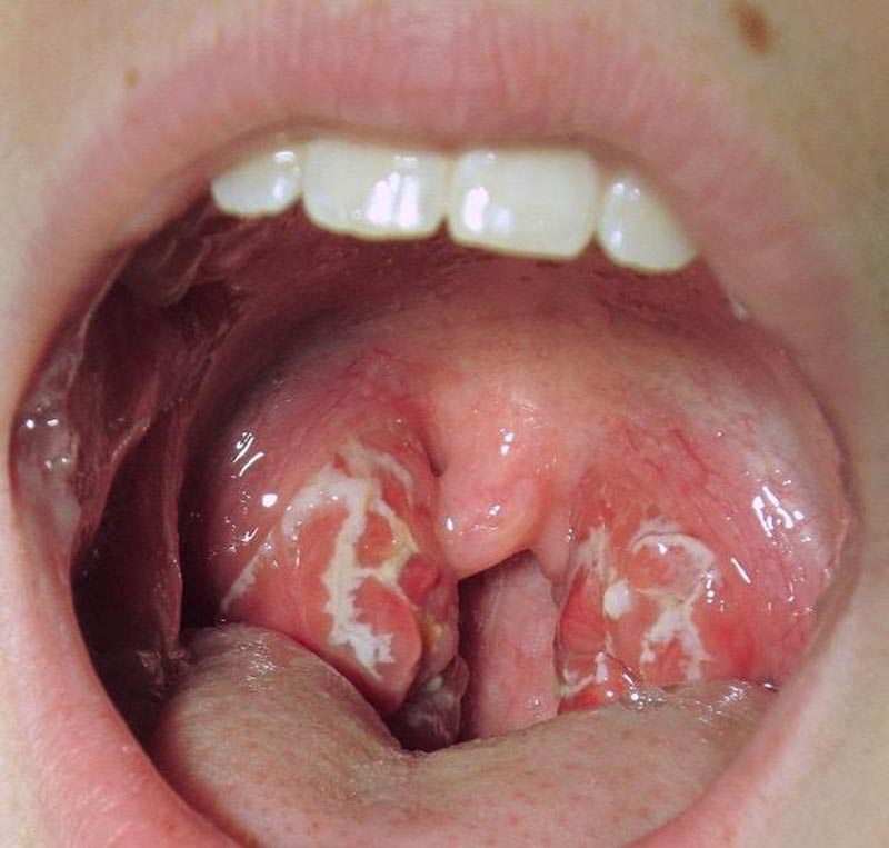 Viêm họng mủ là tình trạng viêm nhiễm nghiêm trọng