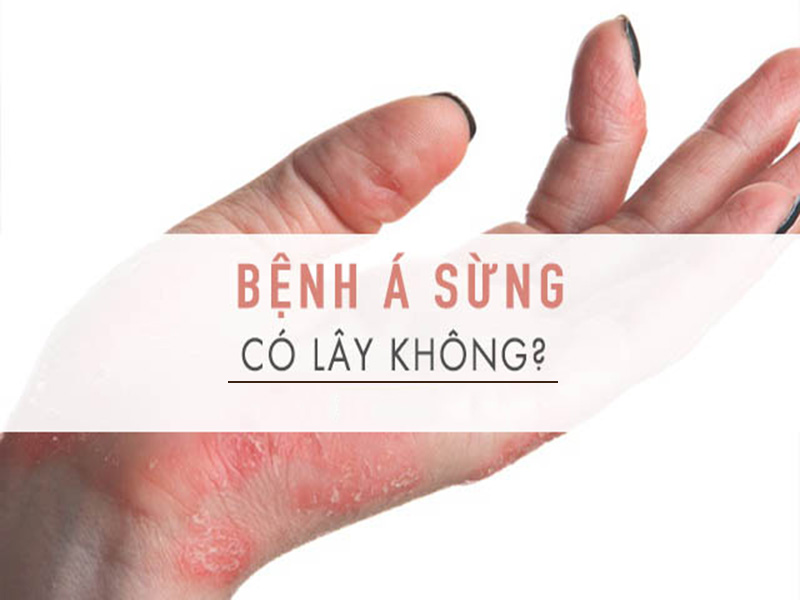 benh-a-sung-co-lay-khong 8