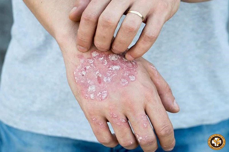 Cào, gãi hoặc tác động lên vùng da bị bệnh có thể làm tăng các tổn thương da