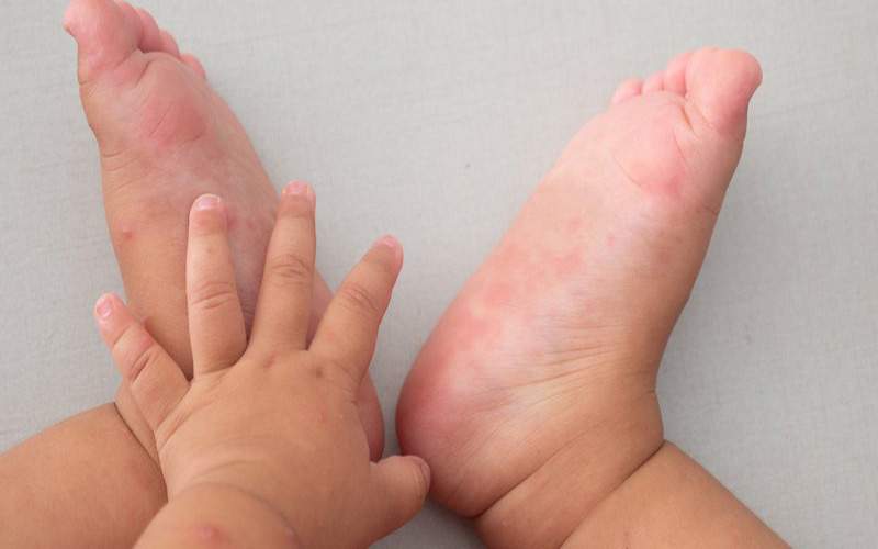 Các mụn nước thường xuất hiện ở bàn chân và bàn tay của trẻ