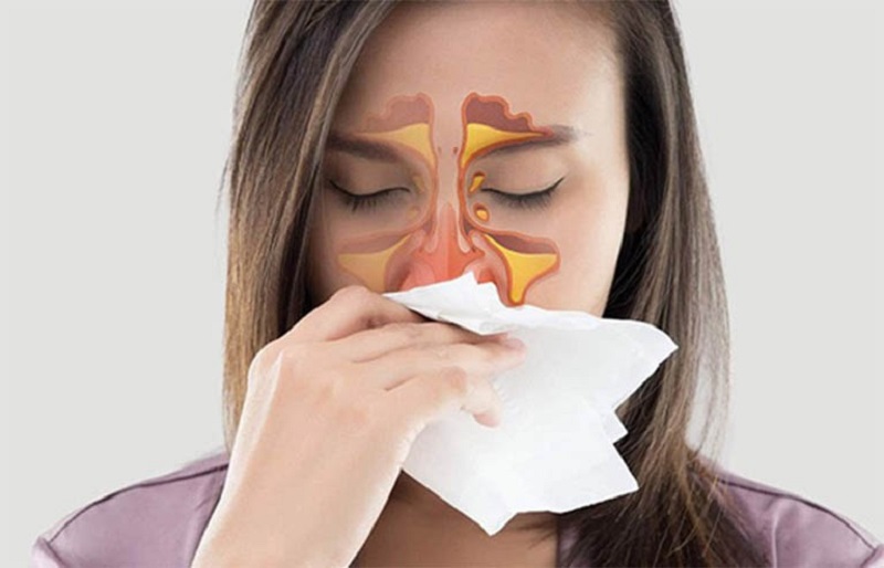 Đau mũi, chảy nước mũi là triệu chứng của viêm xoang mũi