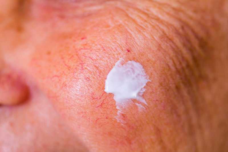 Thuốc bôi trị vảy nến tại chỗ trên da mặt có thể gây mỏng da