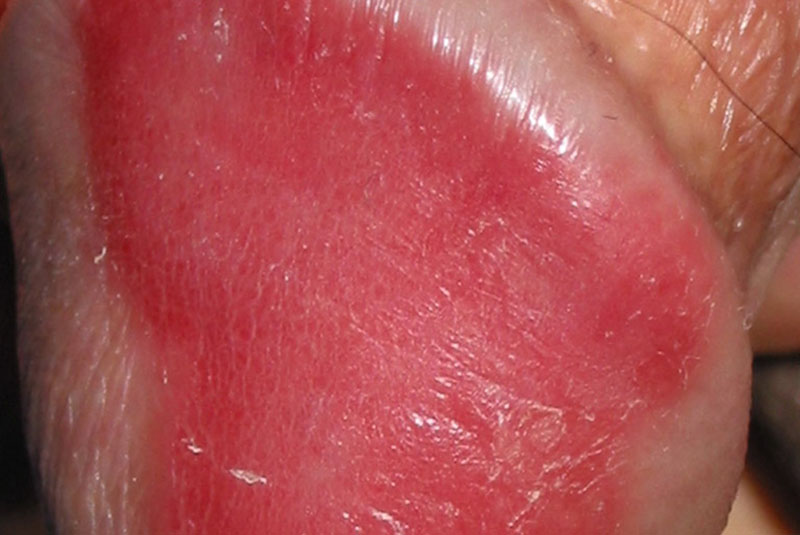 Vảy nến vùng kín gây nên những mảng da màu đỏ tươi, không bong tróc nhưng gây đau ngứa dữ dội