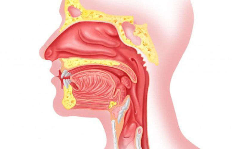 Bệnh lý tai mũi họng mãn tính là nguyên nhân dẫn đến bệnh