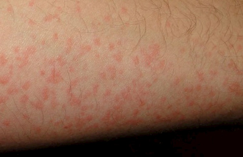 Nổi mẩn đỏ không ngứa là dấu hiệu của rất nhiều bệnh về da thường gặp