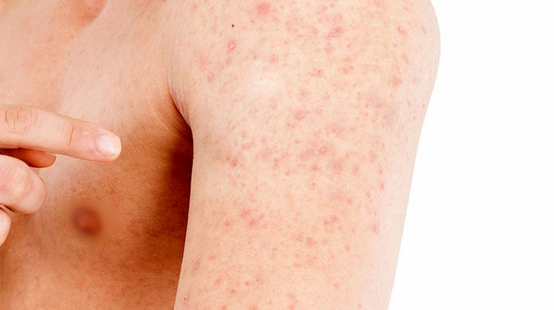 Nổi mẩn đỏ ngứa như muỗi đốt là biểu hiện của một số bệnh ngoài da