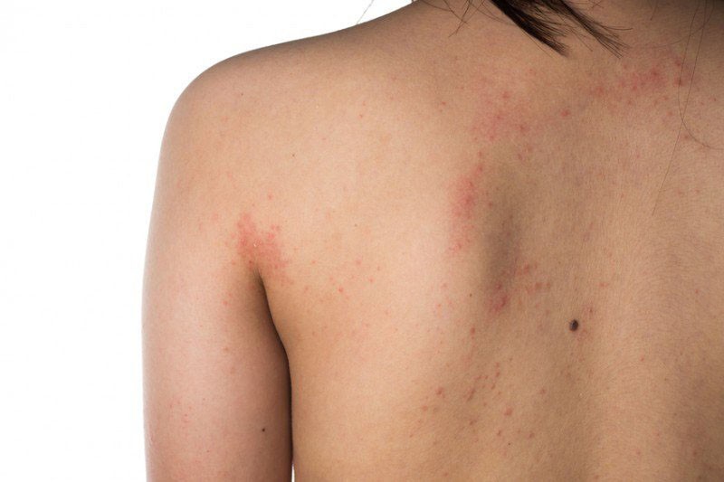 Các đốm đỏ, nốt ruồi xuất hiện bất thường trên da