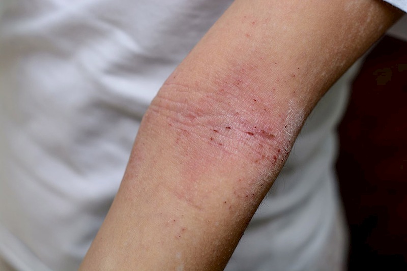 Nổi mẩn đỏ ở tay rất nguy hiểm nếu không điều trị kịp thời