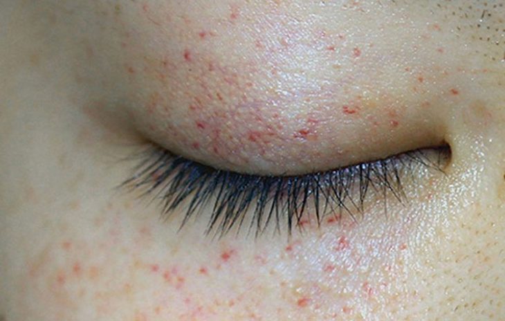 Nổi mẩn đỏ quanh mắt khiến người bệnh ngứa ngáy khó chịu