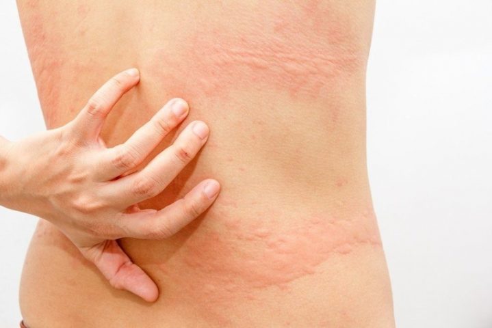 Phát ban đỏ không sốt là bệnh về da thường gặp