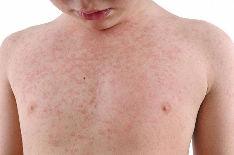 Dấu hiệu ban đầu của sốt phát ban là xuất hiện các mẩn như muỗi đốt trên da 