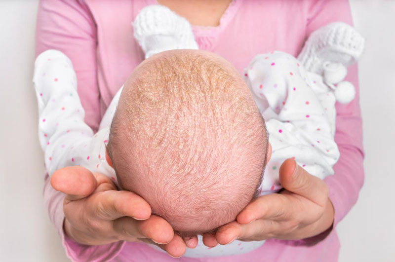 Hình ảnh vảy nến da đầu ở trẻ sơ sinh