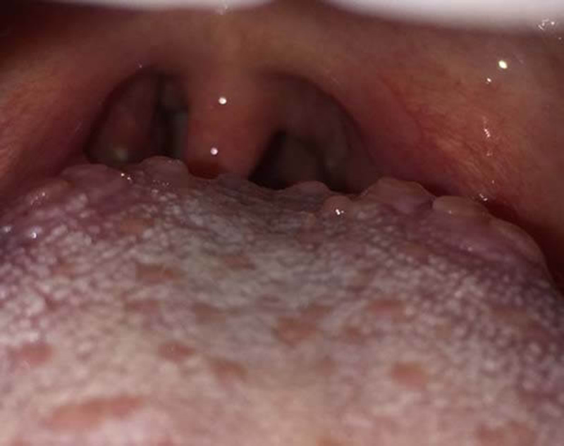 Viêm họng hạt ở lưỡi đặc trưng bởi sự xuất hiện nhiều hạt trắng trên lưỡi và cuống lưỡi