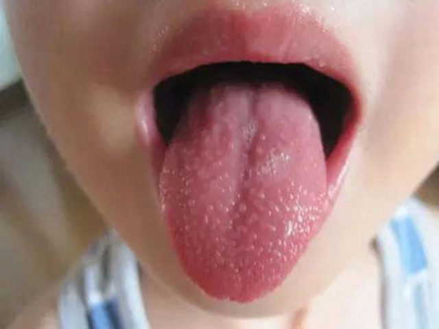 Viêm họng hạt ở lưỡi là một tình trạng nặng, dễ gây biến chứng của bệnh viêm họng