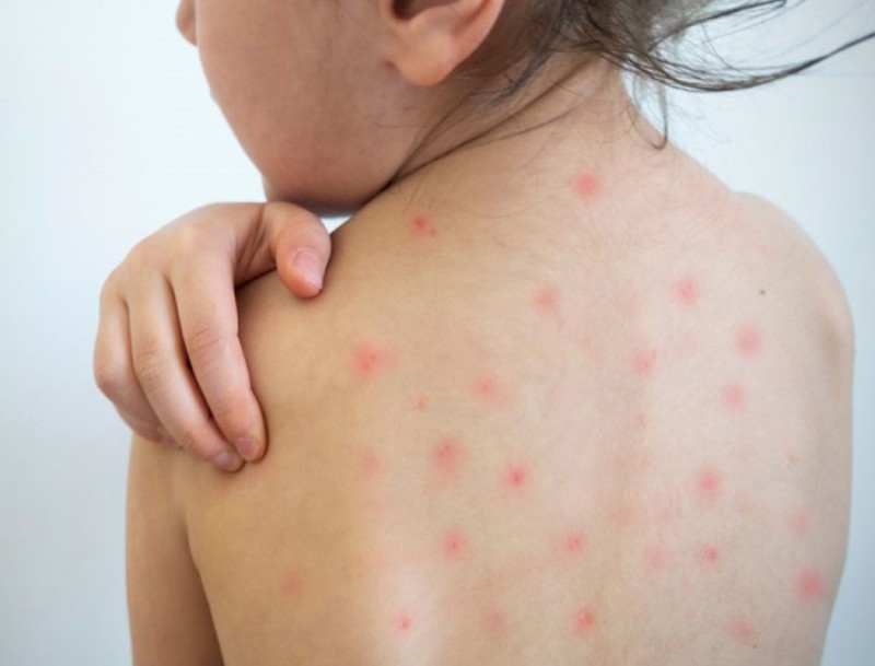 Bé nổi mẩn đỏ khắp người sau sốt là dấu hiệu của bệnh gì? Điều trị thế nào?