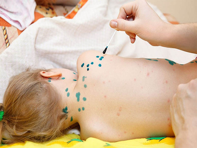 Trẻ bị viêm da virus thủy đậu có thể để lại sẹo, di chứng nếu không được điều trị đúng cách