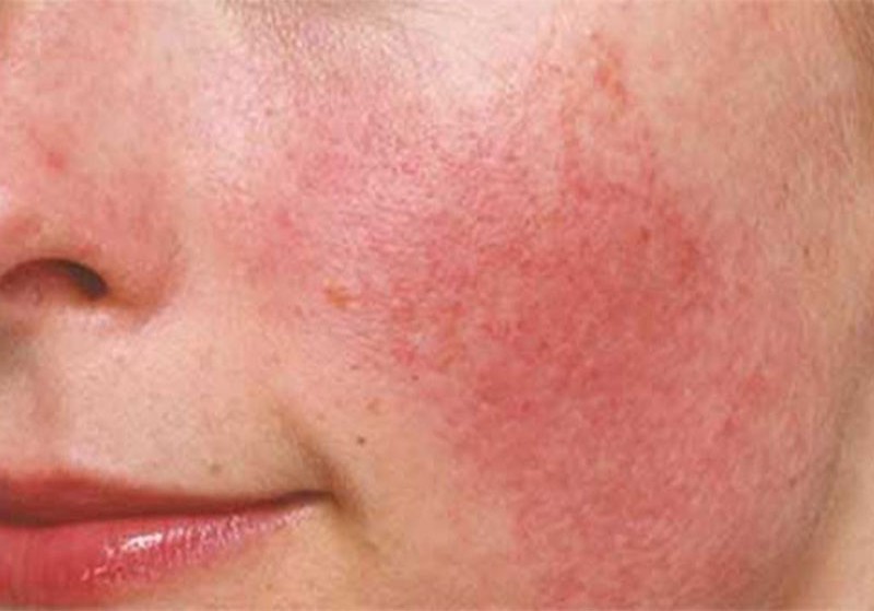 Da mặt khô ngứa mẩn đỏ do tình trạng mề đay