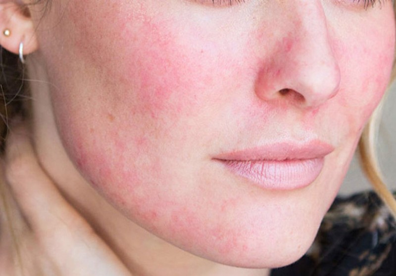 Da mặt khô ngứa mẩn đỏ có nguy hiểm không? Điều trị thế nào?