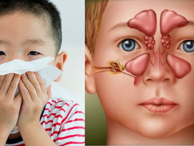 Dịch mũi của trẻ có màu vàng hoặc xanh, mùi hôi là biểu hiện của viêm xoang