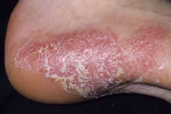 Bệnh vảy nến là một trong những nguyên nhân gây nổi mẩn ngứa ở chân, tay