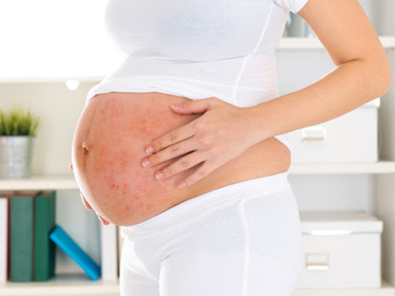 Phụ nữ có thai là đối tượng có nguy cơ cao dễ bị nổi mề đay