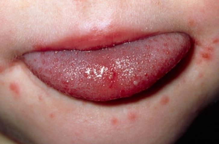 Nước bọt, sữa trào ra ngoài khiến vùng da miệng bị nổi mẩn đỏ