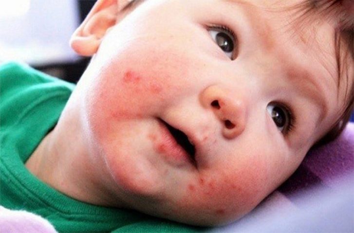 Bệnh chàm sữa cũng là nguyên nhân gây nổi mẩn đỏ quanh miệng trẻ