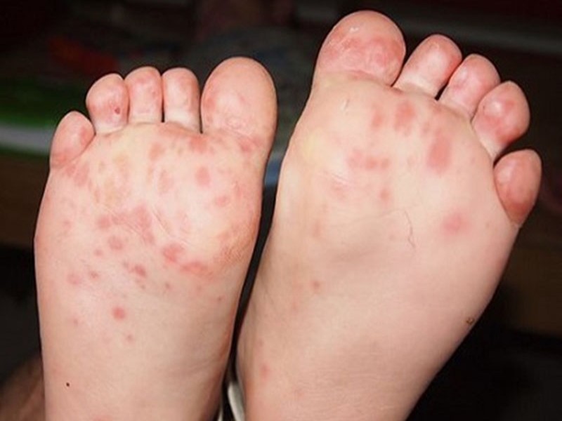 Bệnh sởi là nguyên nhân khiến trẻ sơ sinh bị nổi mẩn đỏ ở chân tay