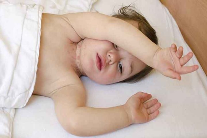 Sốt phát ban có thể là nguyên nhân khiến trẻ sơ sinh bị nổi mẩn đỏ ở cổ