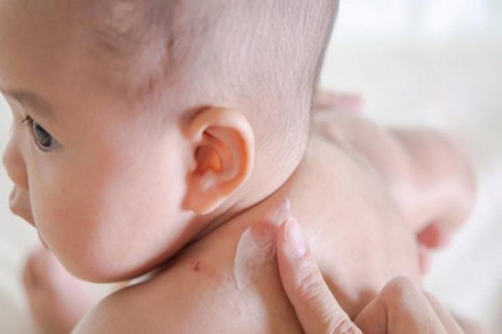 Sử dụng thuốc trị mẩn ngứa bôi ngoài da cho bé sơ sinh