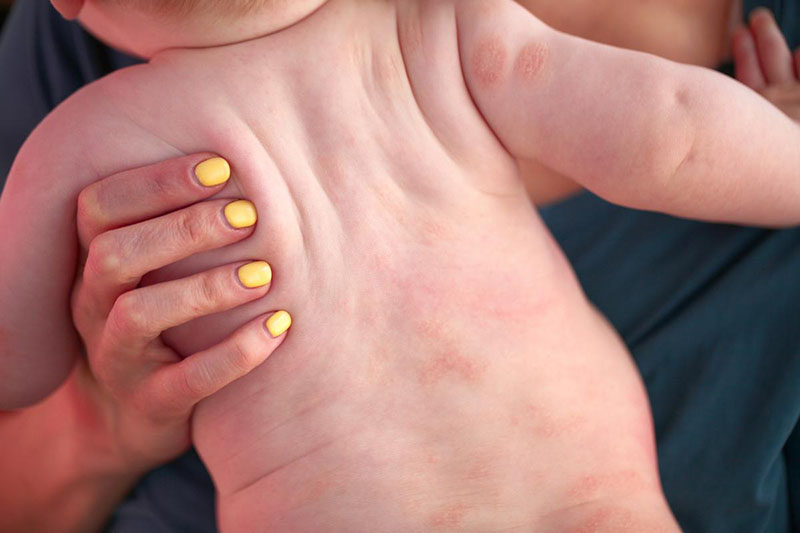 Viêm da dị ứng thường phổ biến hơn ở trẻ sơ sinh và trẻ nhỏ
