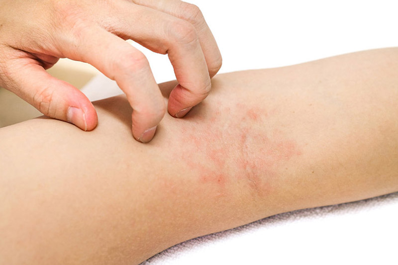 Viêm da là tình trạng tổn thương ngoài da phổ biến trong đời sống