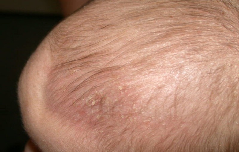 Nguyên nhân gây viêm da tiết bã da đầu