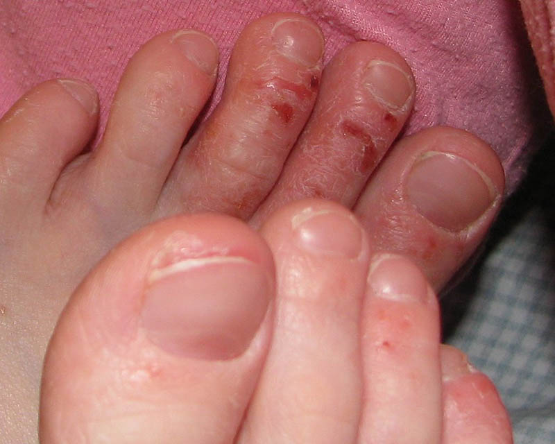 Viêm da cơ địa ở chân thường bắt đầu bởi dấu hiệu mẩn đỏ, bong tróc và ngứa ngáy