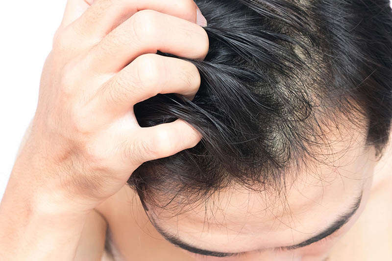 Ngứa là triệu chứng phổ biến gặp ở hầu hết các ca bệnh viêm da cơ địa trên đầu