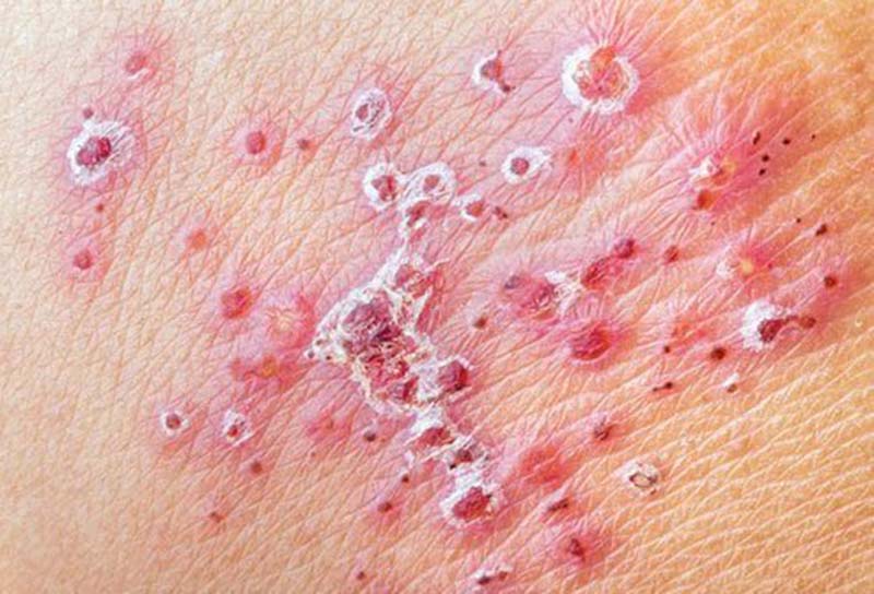 Nhiễm trùng da, sẹo thâm là những biến chứng thường gặp ở những người bị ngứa da nổi mụn nước