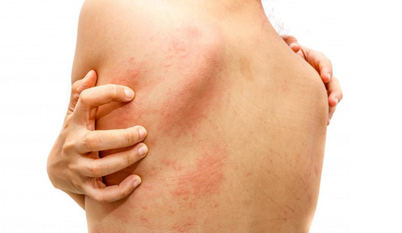 Vệ sinh kém là một trong những nguyên nhân phổ biến gây ngứa da, mụn nước