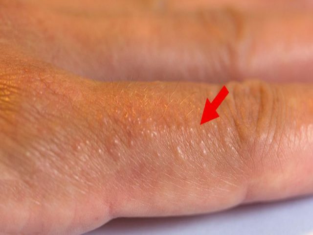 Da nổi mụn nước đỏ không ngứa là một dạng tổn thương ngoài da phổ biến, có thể tiềm ẩn nhiều nguy cơ bệnh lý nguy hiểm