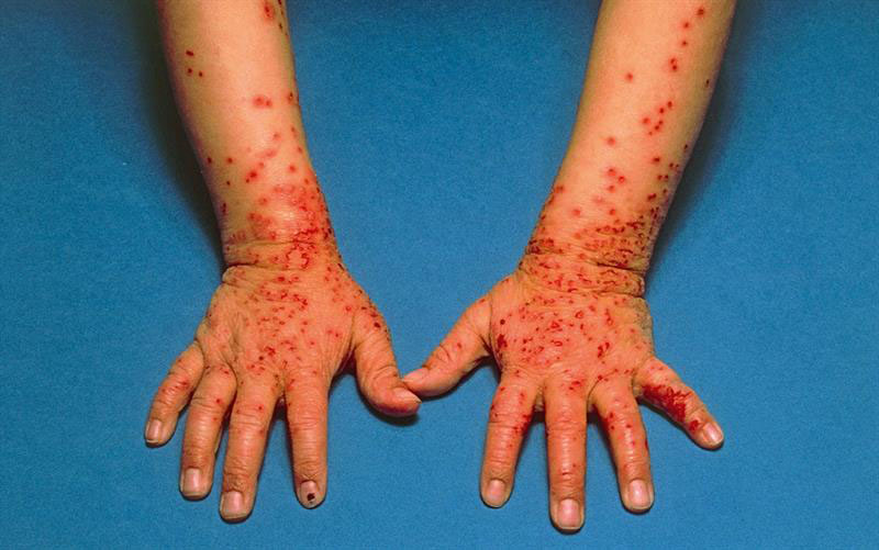 Các tổn thương ngoài da có thể dẫn tới nhiễm trùng và sẹo thâm, đặc biệt là khi mụn nước bị vỡ
