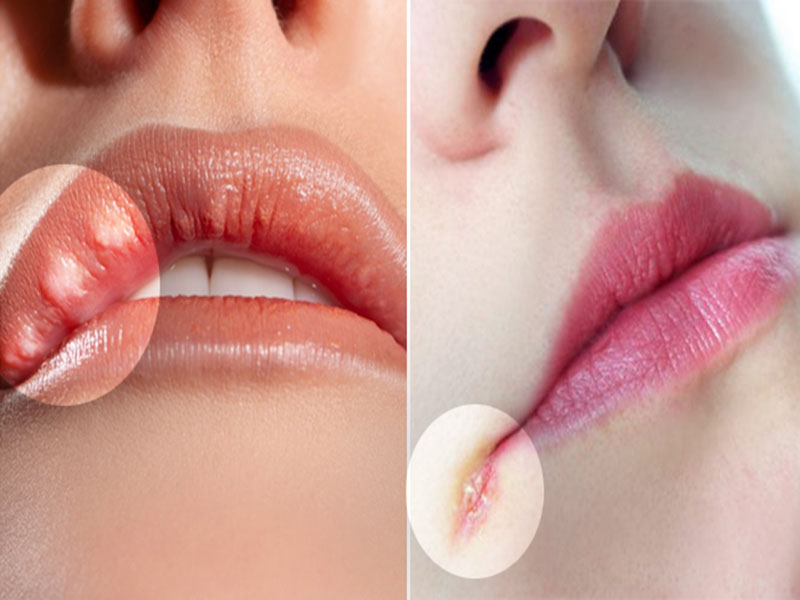 Ngứa môi là một dang kích thích vùng da ở môi, khiến người bệnh cảm thấy khó chịu và muốn cào gãi