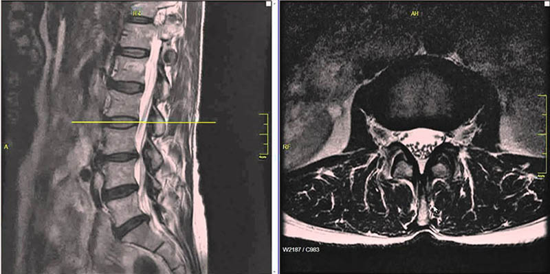 Chẩn đoán hình ảnh đánh giá tình trạng thoát vị đĩa đệm cột sống thắt lưng