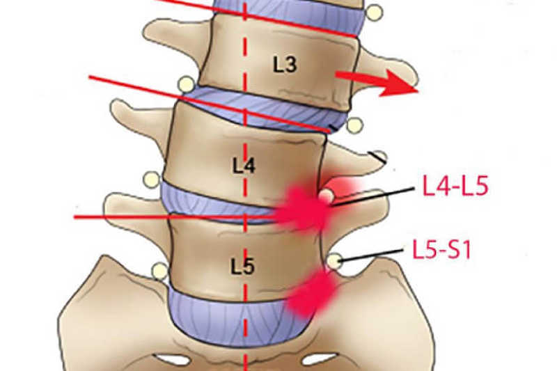 Thoát vị đĩa đệm L4 L5 là tình trạng nhân nhầy thoát ra bên ngoài chèn ép lên các dây thần kinh
