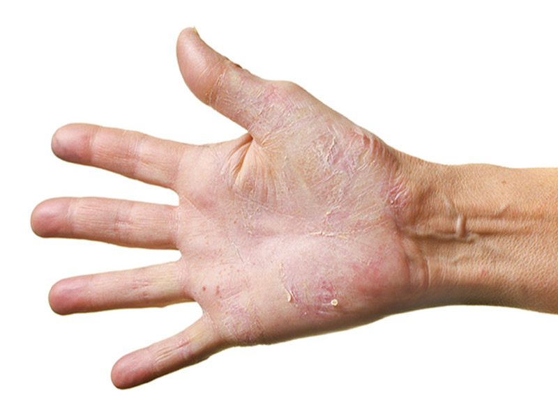 Các triệu chứng viêm da tiếp xúc ở tay có thể dễ nhầm lẫn với một số bệnh lý da liễu khác