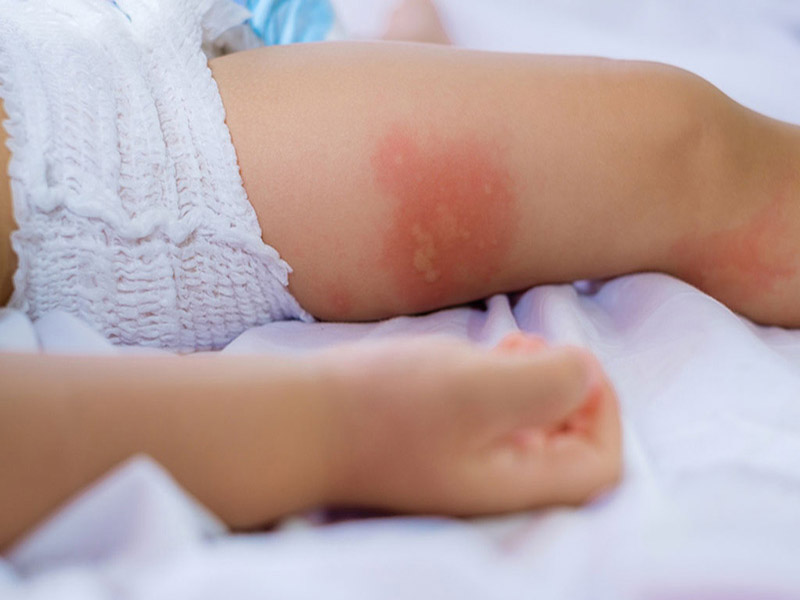 Các triệu chứng viêm da tiếp xúc ở trẻ thường chỉ xảy ra ngay tại vị trí tiếp xúc