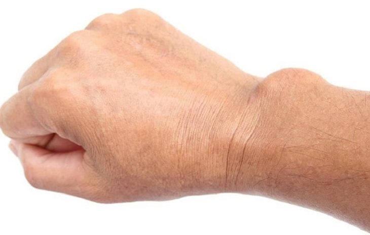 Viêm bao hoạt dịch khớp cổ tay là gì