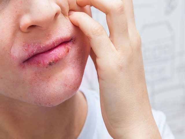 Viêm da cơ địa ở mặt, môi - Dấu hiệu và cách điều trị không để lại sẹo?